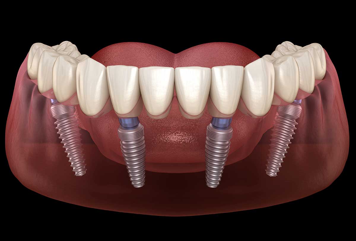 American Dental Supply # PM101-4