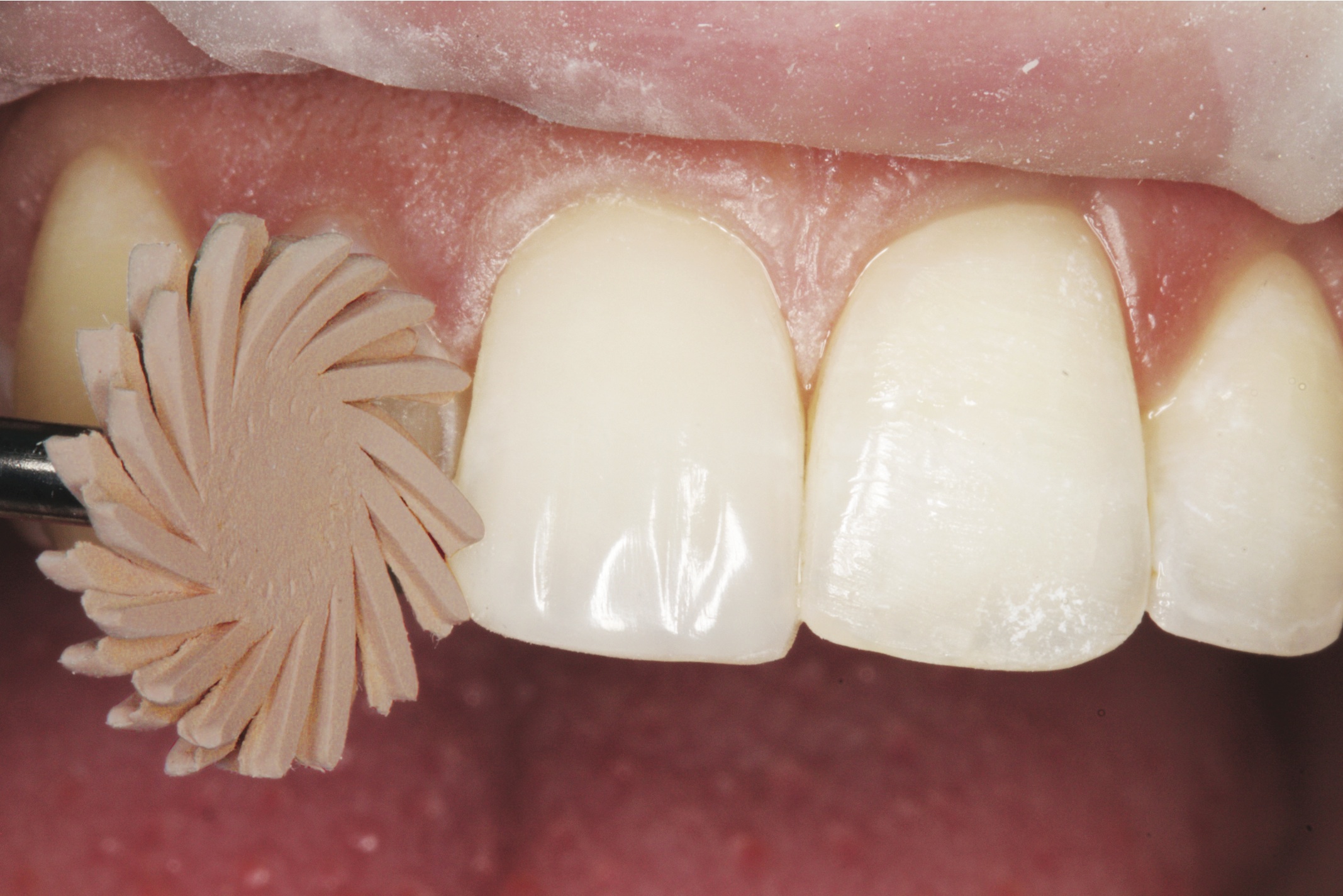 Clinician's Choice Dental # 132014