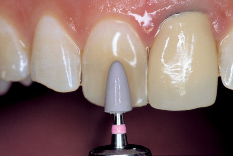 Clinician's Choice Dental # 71608