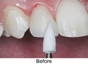 Clinician's Choice Dental # 78206